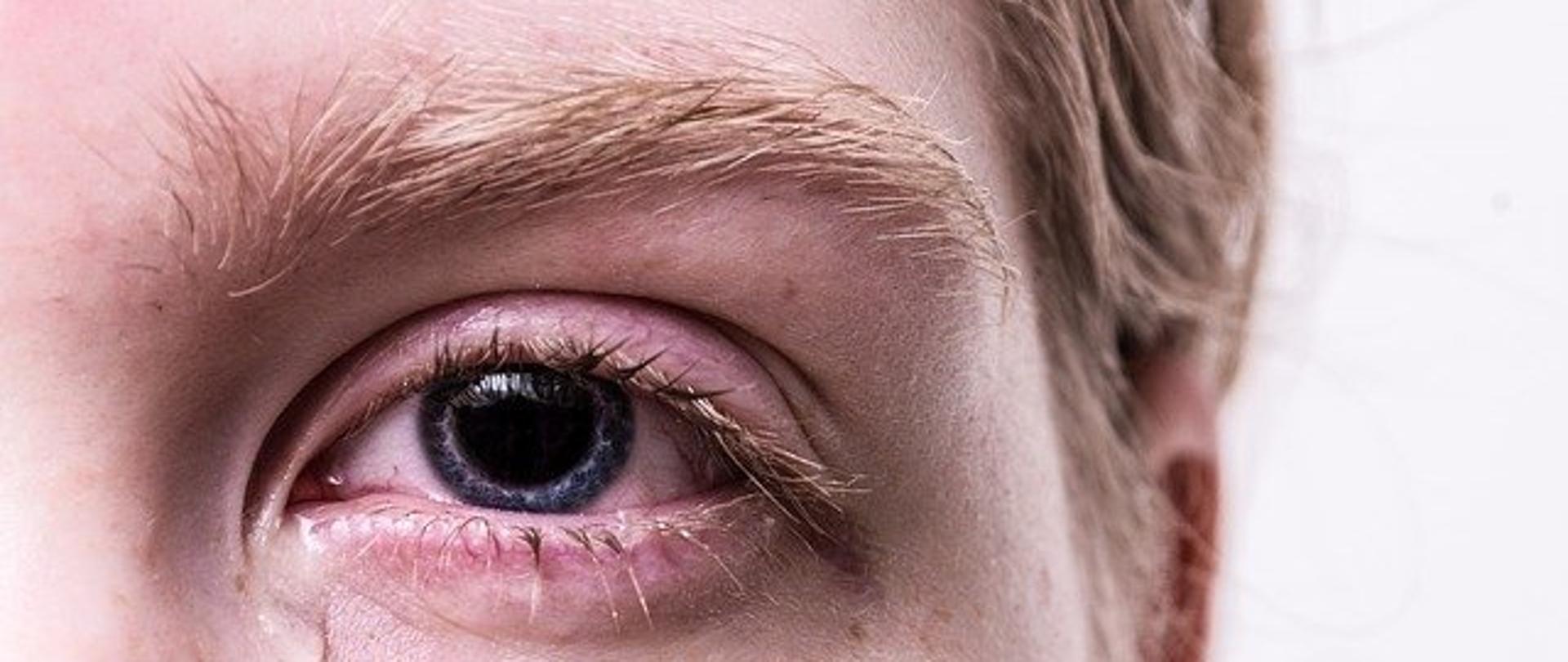 Zdjęcie fragmentu twarzy osoby dotkniętej przemocą: załzawione, podkrążone oko